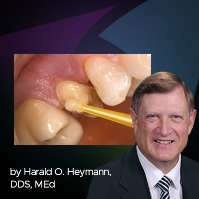 Desensitization Protocol for Crowns Using G5