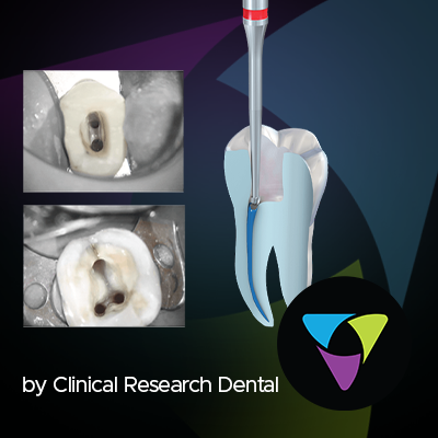 Introducing Komet® Diamonds &amp; Carbides for Endodontics