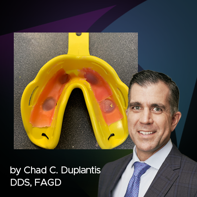 Simplifying the Process of Full Arch Implant Impressions Without Compromise to Accuracy