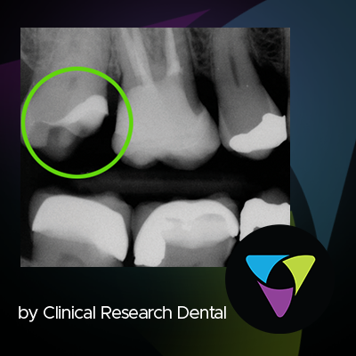 tooth x-ray with green circle