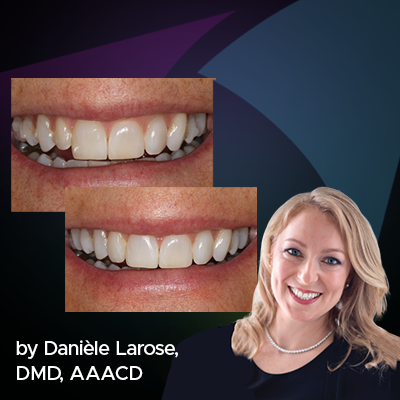 Restoring a Lateral Incisor to Proper Dimensions After Orthodontic Treatment