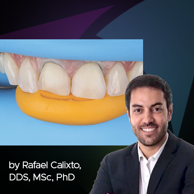 Clinical Guide: Class II Restoration of Maxillary Central Incisors