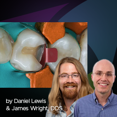 Clinical Guide: Class II Restoration of First Premolar with Interproximal Decay