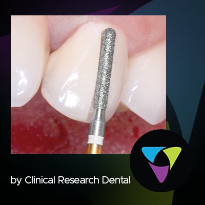 five Komet burs to have in your dental practice: 8833 diamond trimming bur, 4ZR zirconia cutter diamond, H379Q tungsten carbide palatal/occlusal finisher, H33l surgical length carbide bur, 856 XC tapered chamfer diamond preparation bur