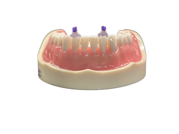 Load image into Gallery viewer, Bioclear™ Tooth & Surface Specific (TSS) Anterior Matrix Refills