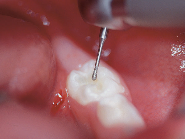 Load image into Gallery viewer, 830RM diamond bur clinical application