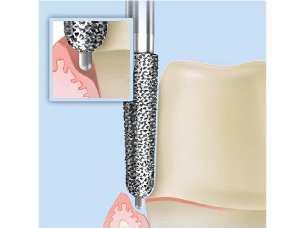 Load image into Gallery viewer, example of use: 856P diamond pin during crown prep