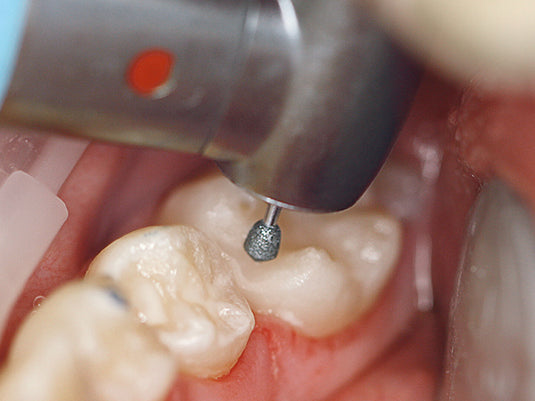 8905 acorn-shaped fine diamond during occlusal trimming