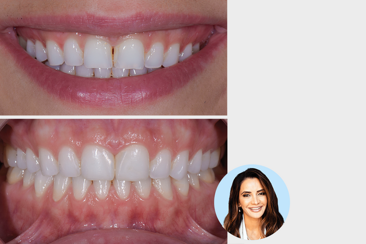 Patient Management and Treatment of the Midline Diastema