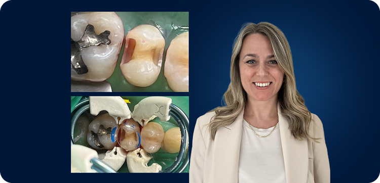 Wide Radius Bevels Create Compression by By Marie-France Roux, DMD