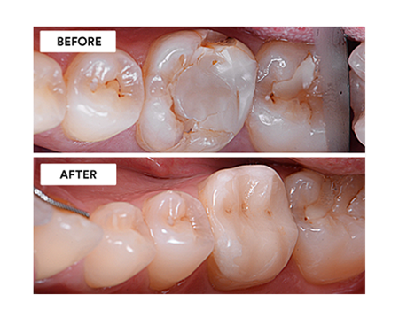 Clinical Case: Preserve & protect: Adhesive endocrown restoration