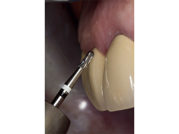 Chargez l'image dans la visionneuse de la galerie, H4MCL crown cutter in a patient mouth at an angle of 45 degrees
