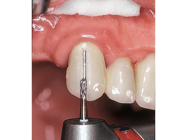 Chargez l'image dans la visionneuse de la galerie, H4MCL crown cutter removes a PFM crown