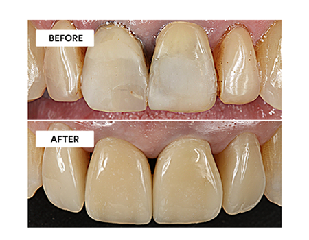 Clinical Case: Masking Discolored Teeth