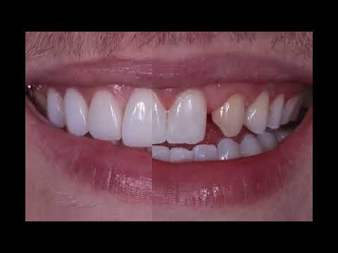 Load and play video in Gallery viewer, Cosmedent® Renamel® OPALITE™ Microfill Composite