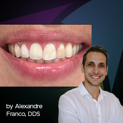 The Importance of a Correct Diagnosis for a Correct (and Effective) Teeth Whitening Treatment