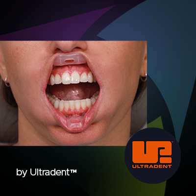 The Umbrella Tongue, Cheek and Lip Retractor: A New, Fresh Design in Soft Tissue Retraction from Ultradent