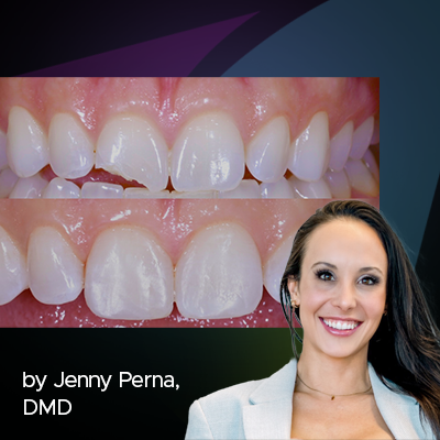 Step by Step Protocol for Consistently Creating Invisible Class IV Restorations