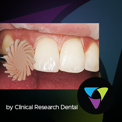 Restorative Dental Polishing Solutions – What to Look For