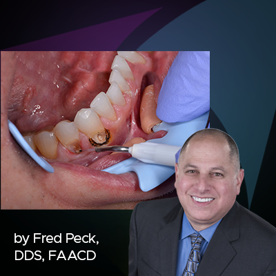 Treating Decay Subgingivally with a Soft Tissue Diode Laser
