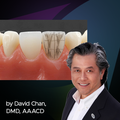 Simple Concepts to Shape and Polish Anterior Composite to Rival Porcelain
