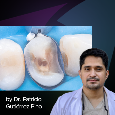 Case Study: Clinical Management of Deep Subgingival Margin Elevation in Posterior Teeth with Structural Compromise