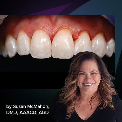Gingival Sculpting With a Soft Tissue Diode Laser