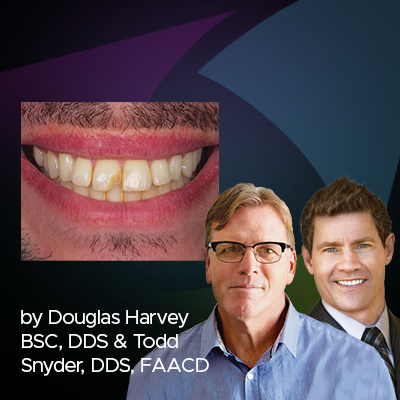 Smile with central incisor before and after restoration