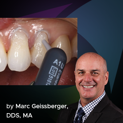 Simple, Beautiful and Predictable Class V Restorations
