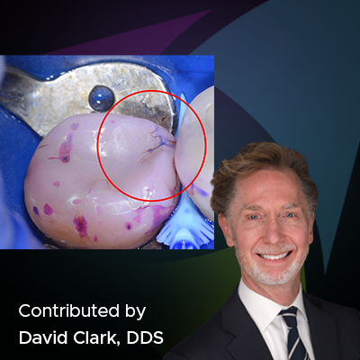 Improving Trust, Value, and Diagnosis with Bioclear Dual Colour Disclosing Solution