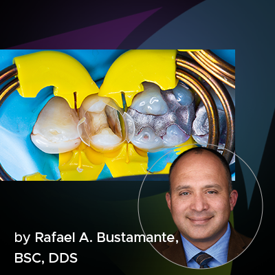 A New Direction in Restoring Interproximal Caries in Posterior Teeth: The Bioclear Method