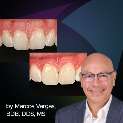 Ultimate Aesthetics Using Non-VITA Shades for Diastema Closure