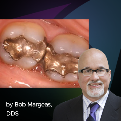 How to Replace Large Amalgam Restorations with Core Material without the Use of Matrix Bands