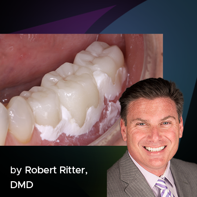 Cementation Technique for Monolithic Zirconia Crowns