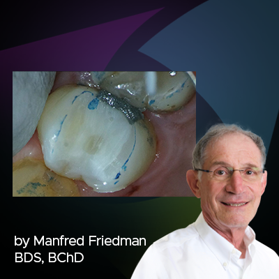 Efficient Post Core Fabrication