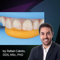 Clinical Guide: Class II Restoration of Maxillary Central Incisors