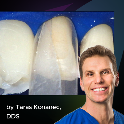 black triangle teeth