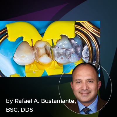 a blog post banner featuring the clinical technique of restoring the interproximal caries with the bioclear method