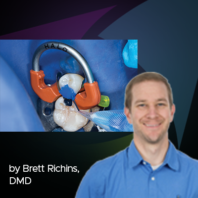 Clinical Guide: Class II Restoration on a Mandibular Second Premolar