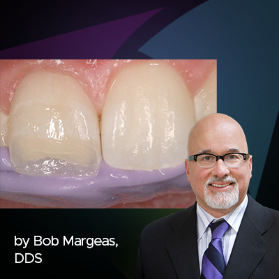 Ask the Expert: An Interview with Bob Margeas, DDS on Universal Composites