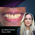Same-Day Rejuvenation: 360˚ Veneers with Bioclear Matrices