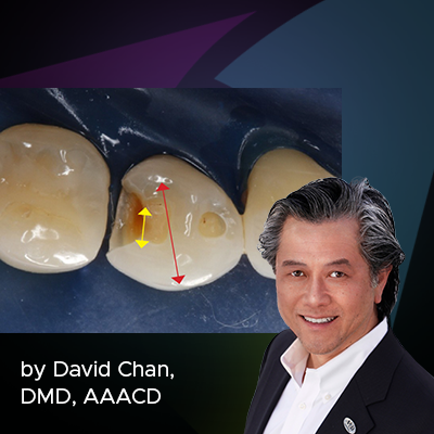 Controlling the Variables for Perfect Class II Restorations