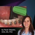 Clinical Case: FitStrip for Brackets