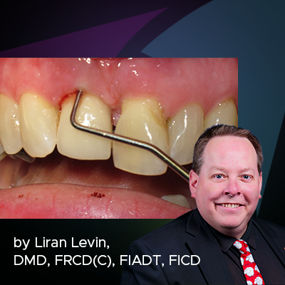 Peri-implantitis – Not on Your Shift!