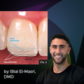 Composite Layering Class IV Fracture Repair Using Nature as a Guide