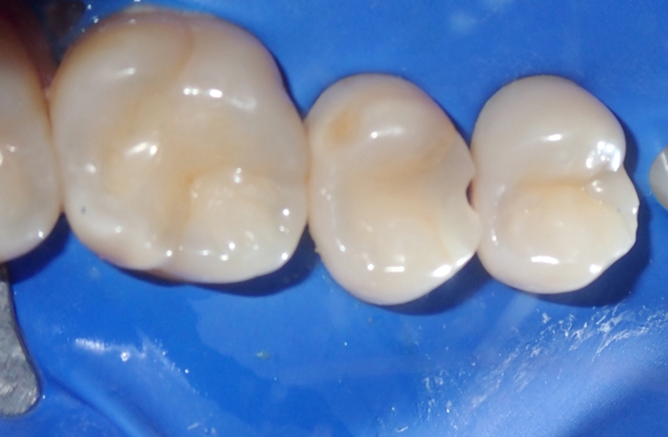 Teeth isolated with blue rubber dam