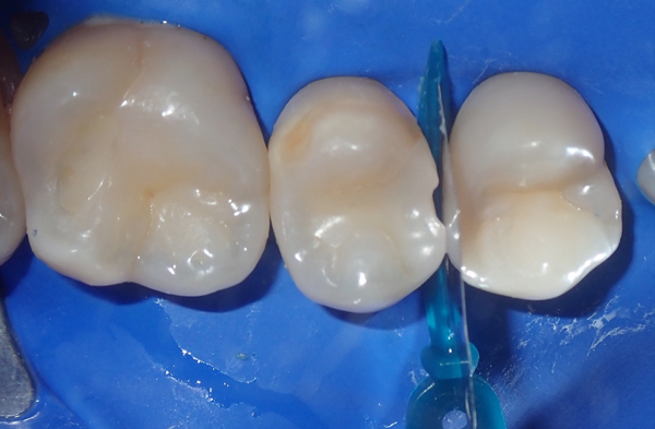 Teeth isolated with rubber dam