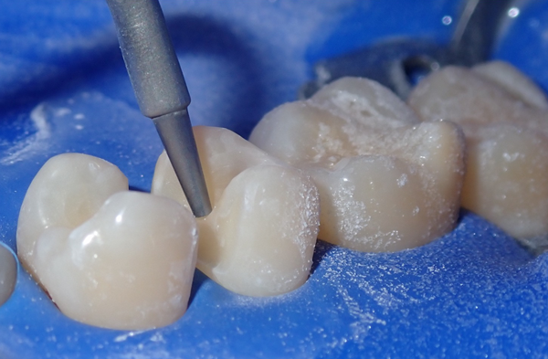 Bur cutting through teeth