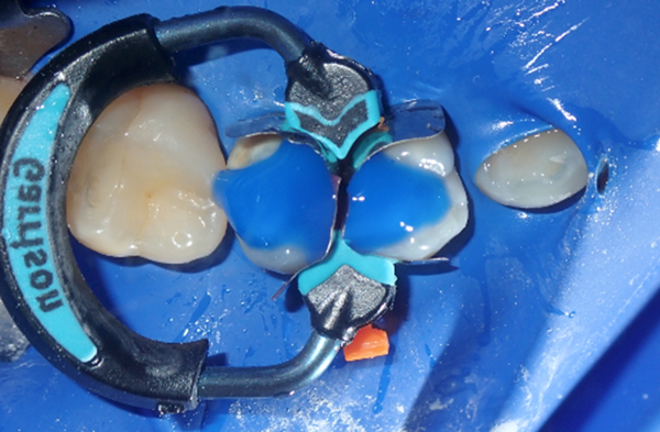 Teeth with matrix ring placed and with blue etch on top