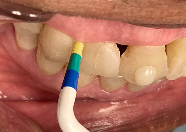 Gauge measuring spacing between teeth